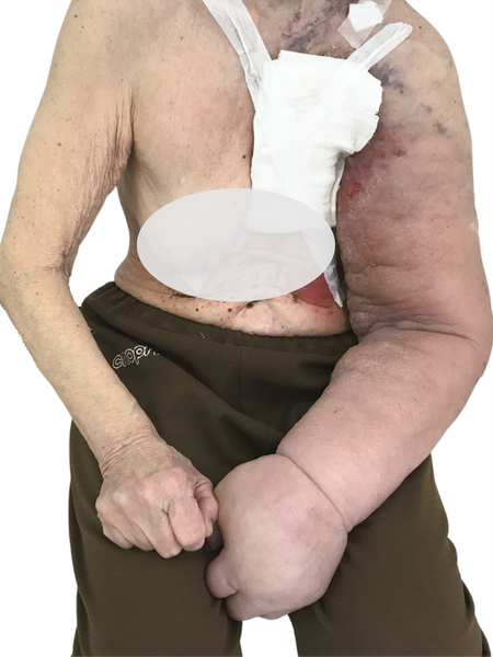 Отёк руки после операции на молочной железе